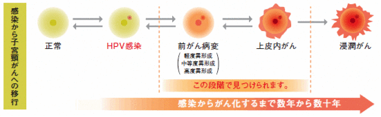 感染から子宮頸がんへの移行