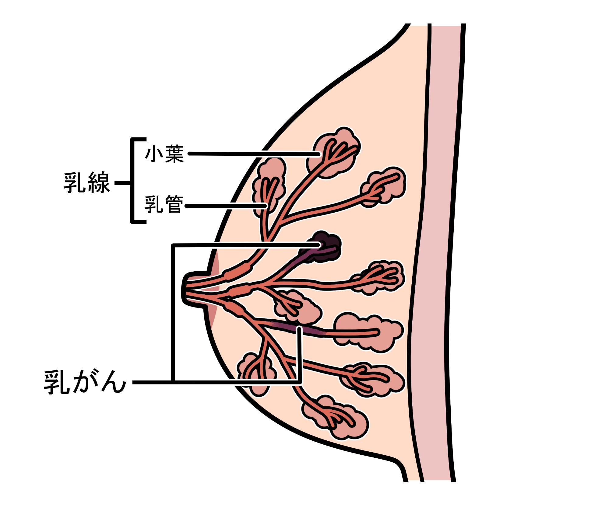 乳がんイラスト