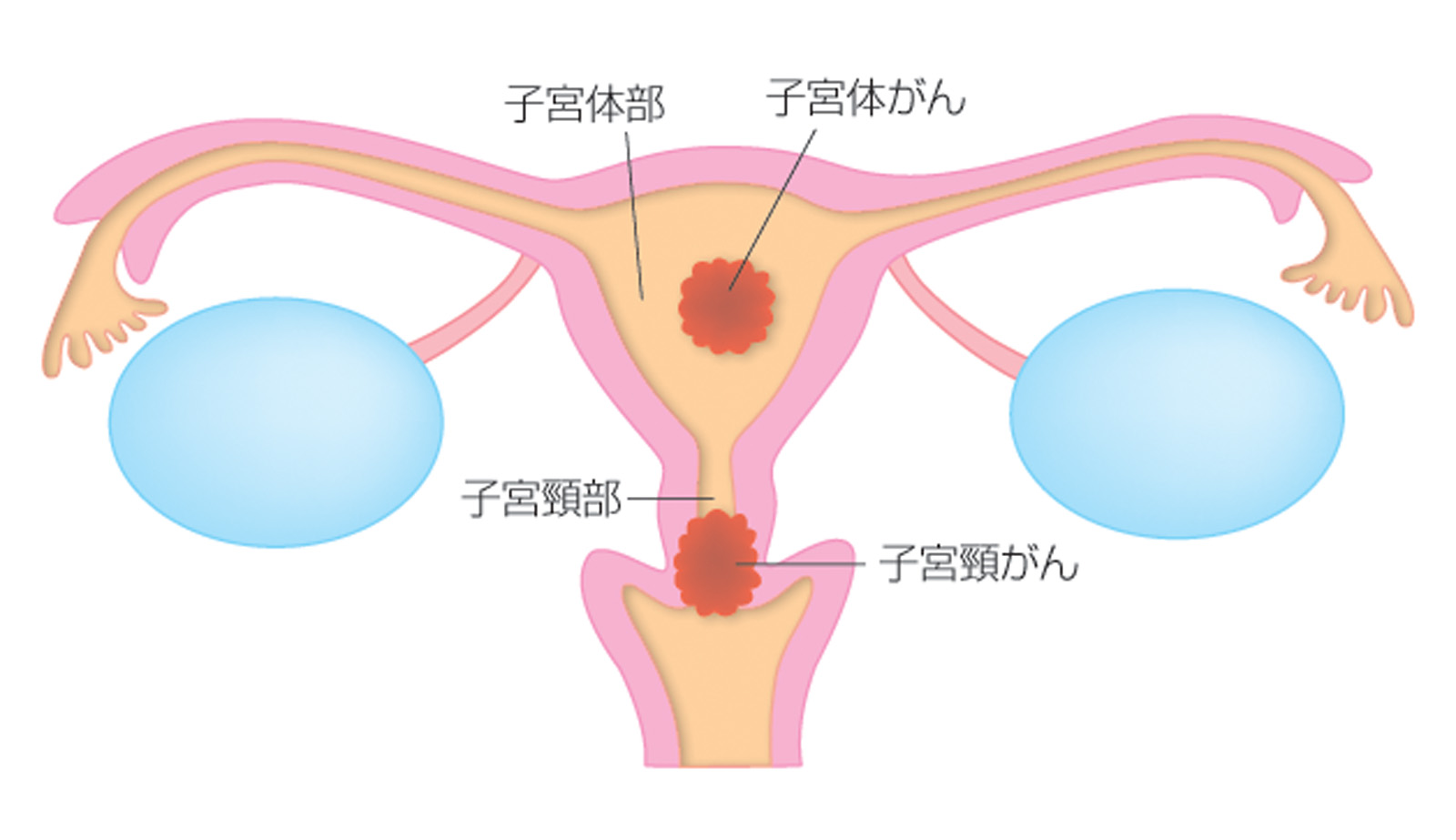 子宮がんイラスト