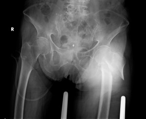 股関節を撮影したレントゲン写真の画像の写真