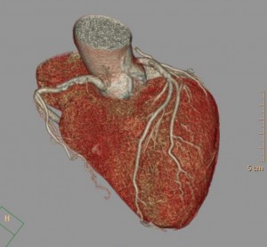 心臓3D化して血管の状態を撮影した冠動脈3D画像の写真