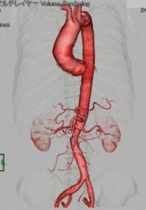 大動脈の部分が赤色に染まり3D化して撮影された大動脈3D画像の写真