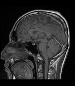 頭部を横から撮影した頭部MRI画像の写真