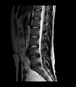 人体を横から撮影した腰椎MRI検査の画像写真