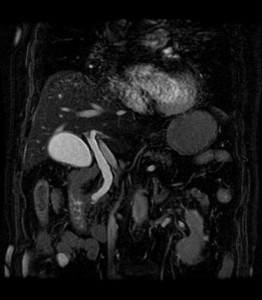 臓器の状態を撮影した腹部MRI検査の画像写真