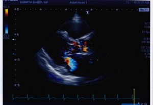 経胸壁検査で映し出された心臓の画像の写真