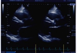 経食道検査で映し出された心臓の2つの画像の写真