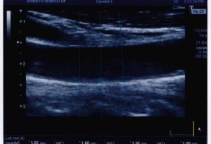 血管の内腔の断像が映し出された血管超音波検査の画像の写真
