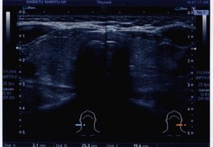 喉の左と右を映し出した甲状腺の超音波検査の画像の写真