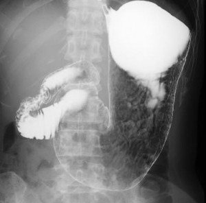 胃の中のバリウムの流れを撮影した胃バリウム検査の透視画像の写真
