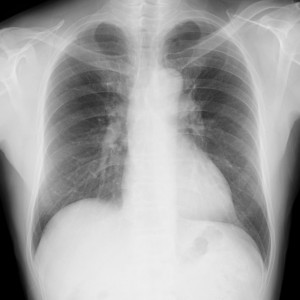 首から下の胸部を撮影した胸部レントゲン検査の透視画像の写真