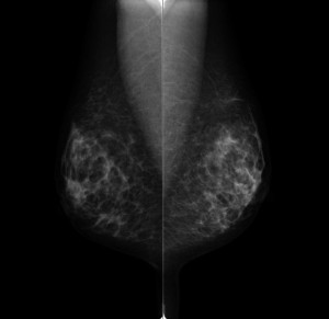 左右の乳房の画像が映し出されたマンモグラフィー検査の透視画像の写真